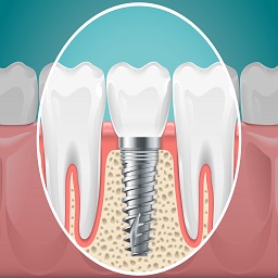 implant