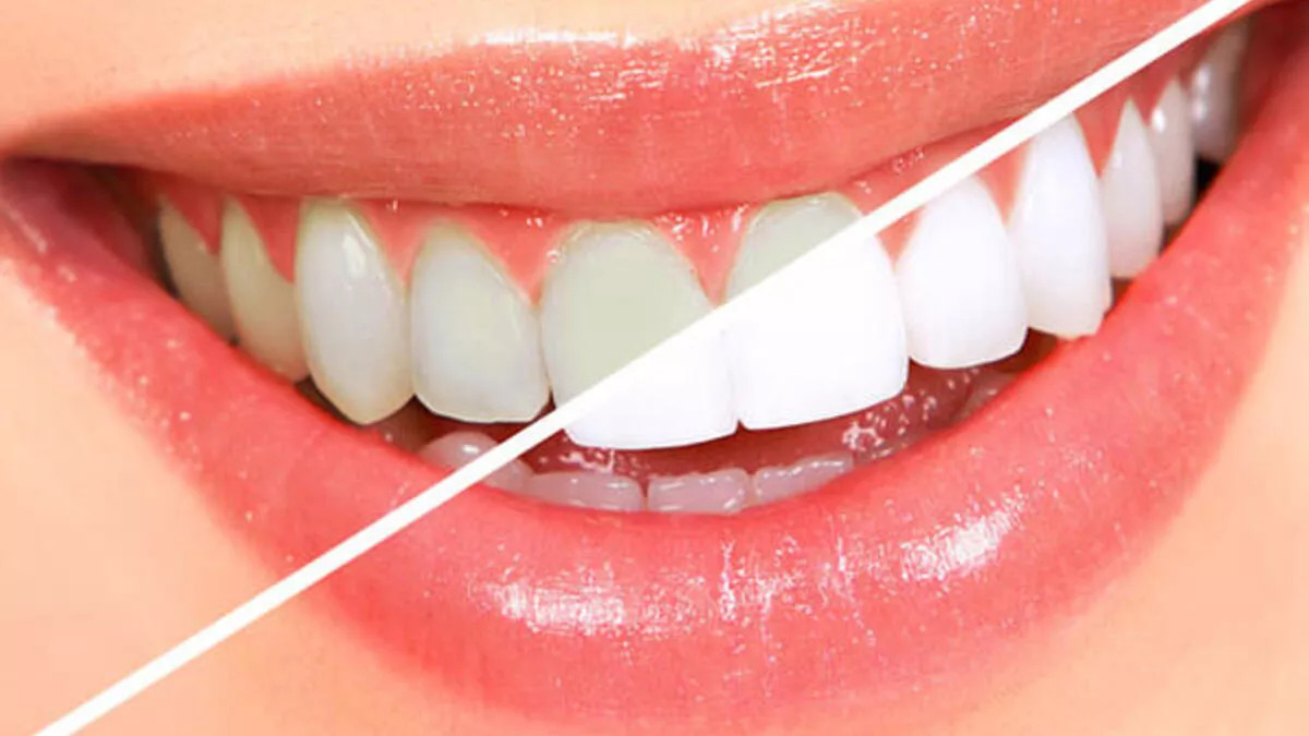 Teeth Whitening