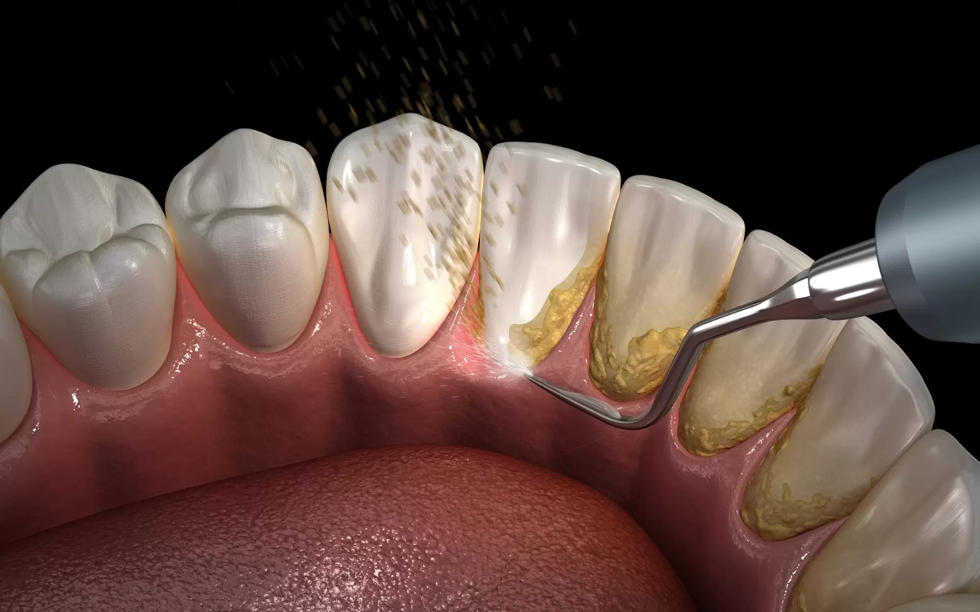 Diş Tartarı (Diş Taşı) Nedir? Neden Olur ve Nasıl Temizlenir?