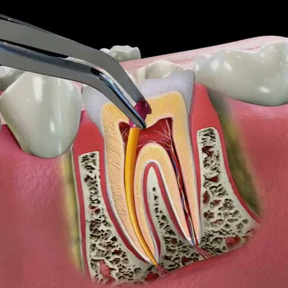 Endodonti (Kanal Tedavisi)