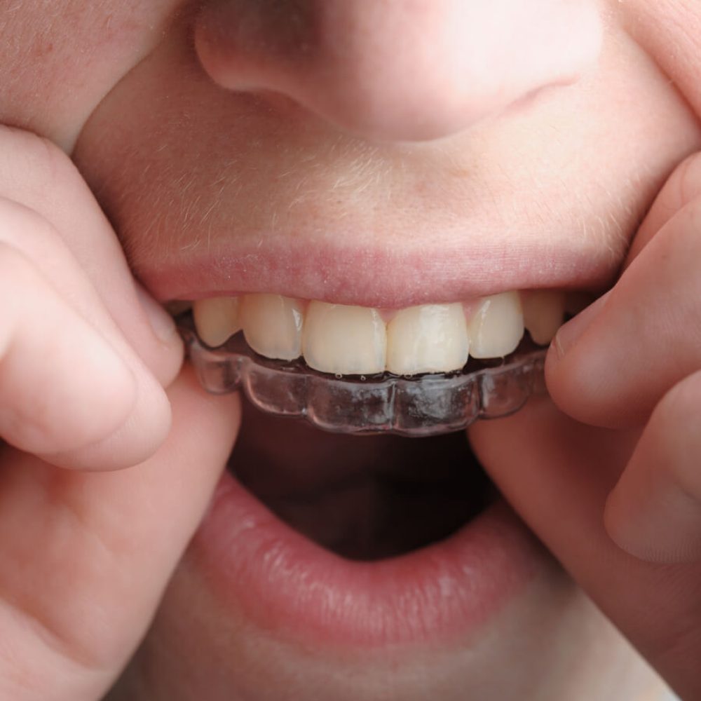 invisalign çocuk